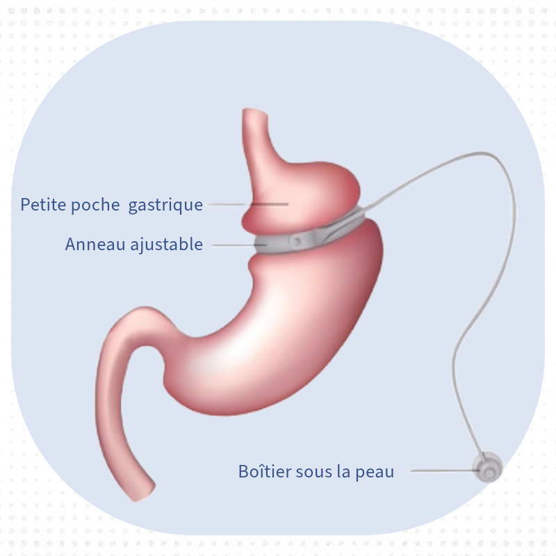 Anneau gastrique ajustable 